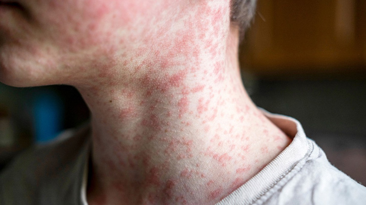 Measles on neck